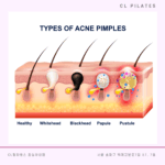 고통스러운 피부 질환, 화농성 한선염 알아보기