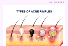 고통스러운 피부 질환, 화농성 한선염 알아보기