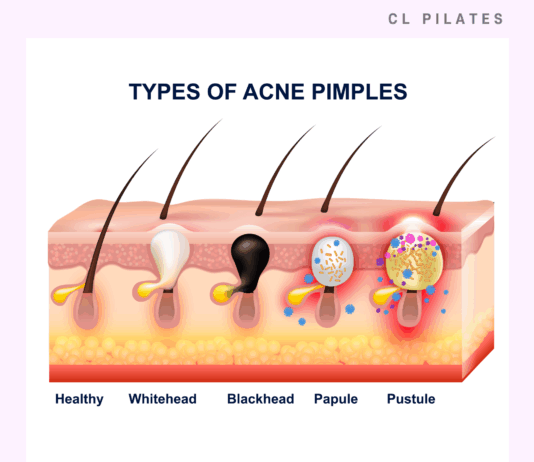 고통스러운 피부 질환, 화농성 한선염 알아보기